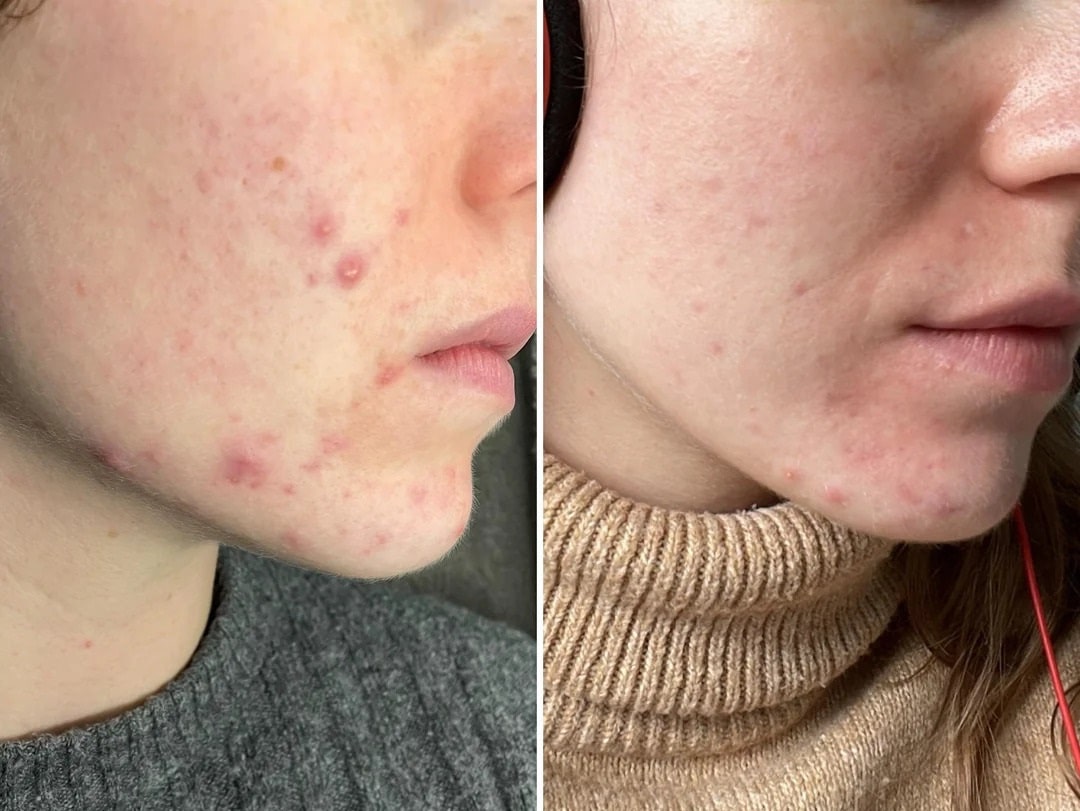 Epiduo gel before-and-after 2 months