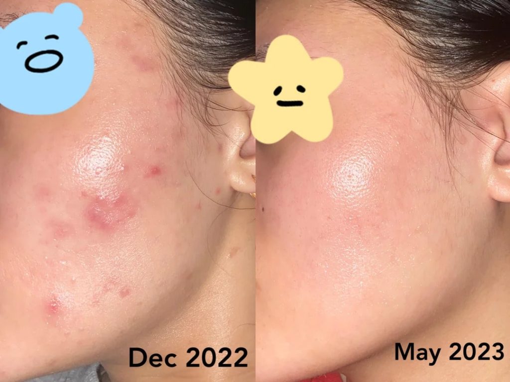 Epiduo gel before-and-after 6 months